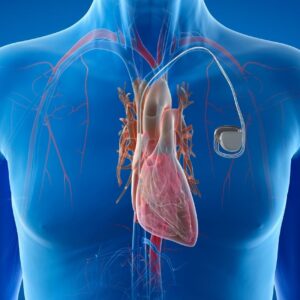 Diploma in pacing (Pacemaker ICD) 1/2