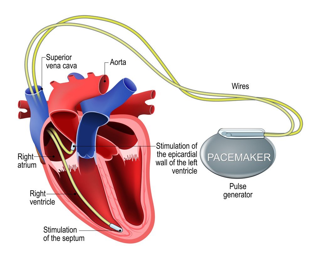 Diploma in Cardiac Device & Rhythm Management